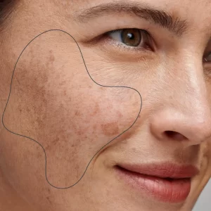 Types of pigmentation on the face by The Skin Esthetic