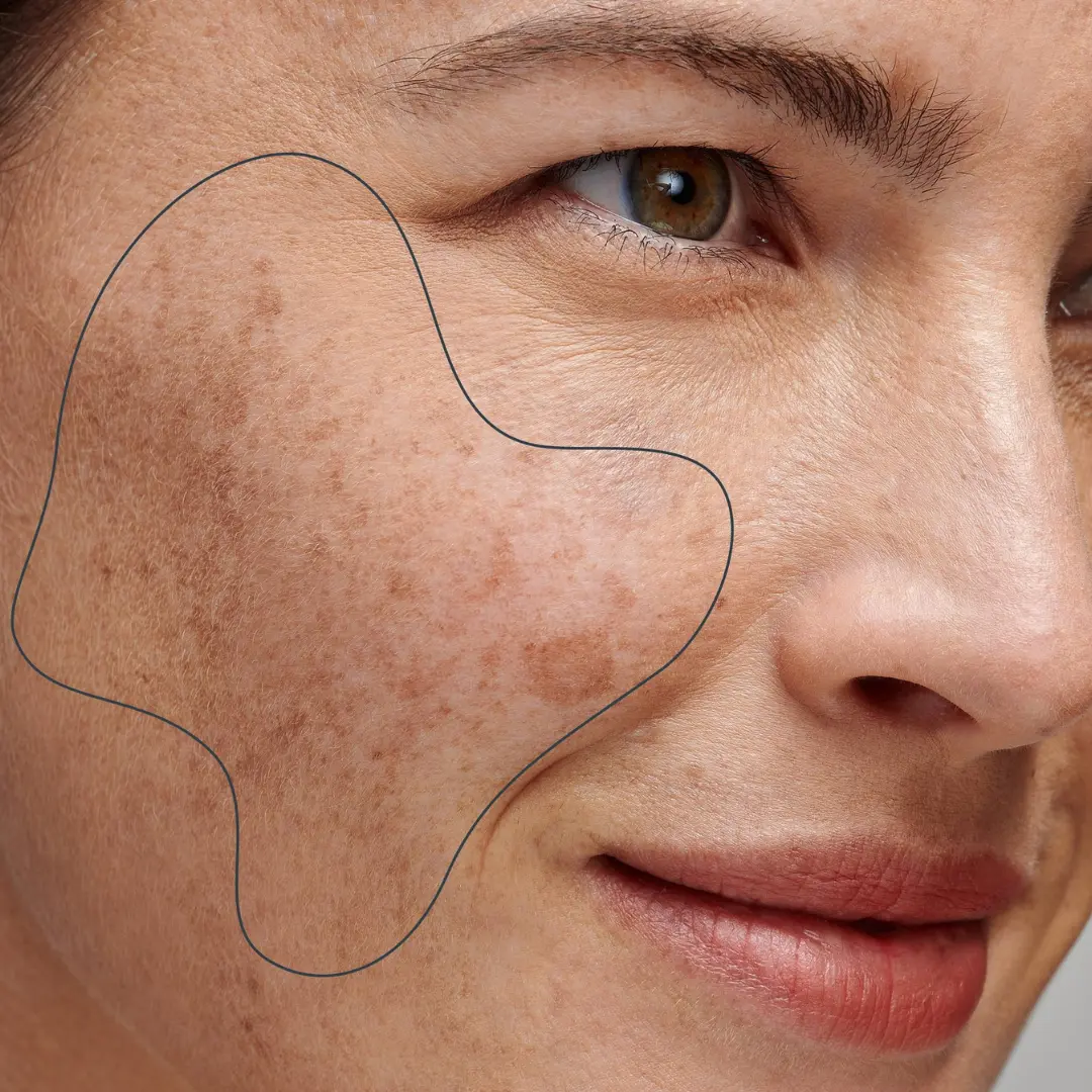 Types of pigmentation on the face by The Skin Esthetic