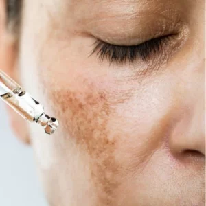 What is the Best Way to Treat Hyperpigmentation by The Skin Esthetic