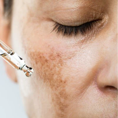 What is the Best Way to Treat Hyperpigmentation by The Skin Esthetic