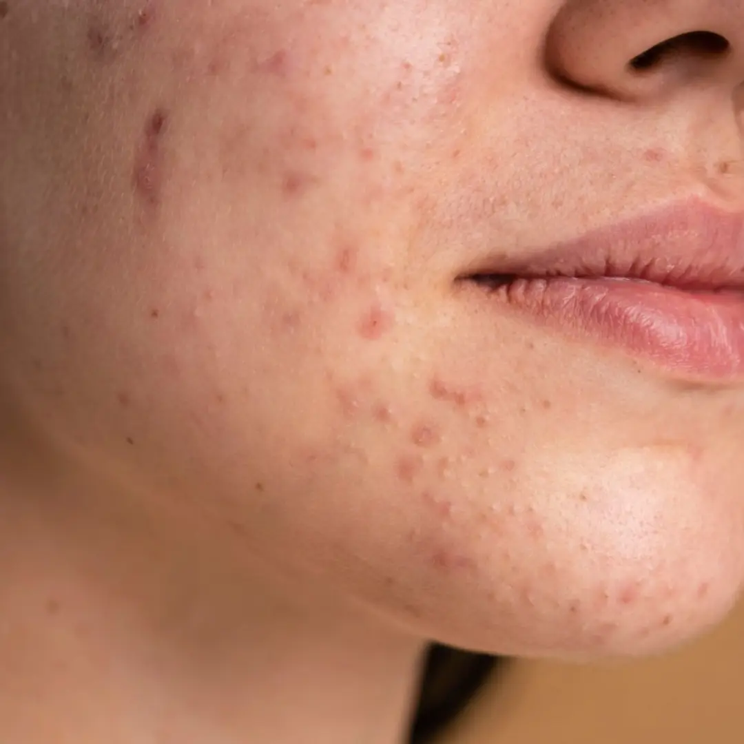 What is the Difference Between Pigmentation and Hyperpigmentation by the Skin Esthetic
