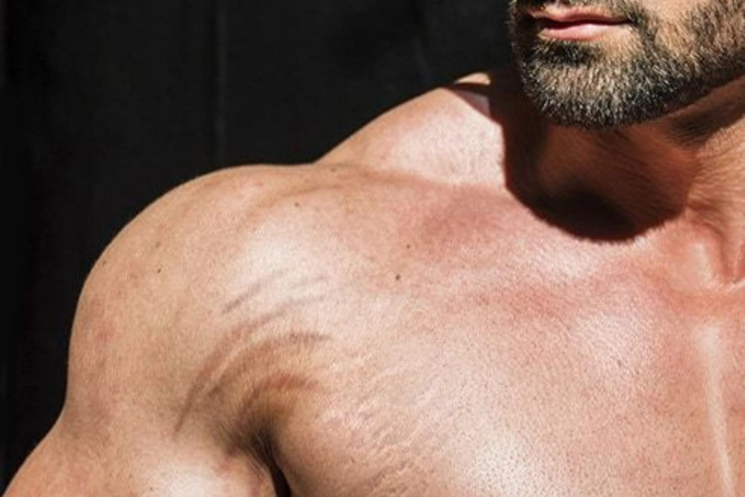 Stretch Marks - The Skin Esthetics