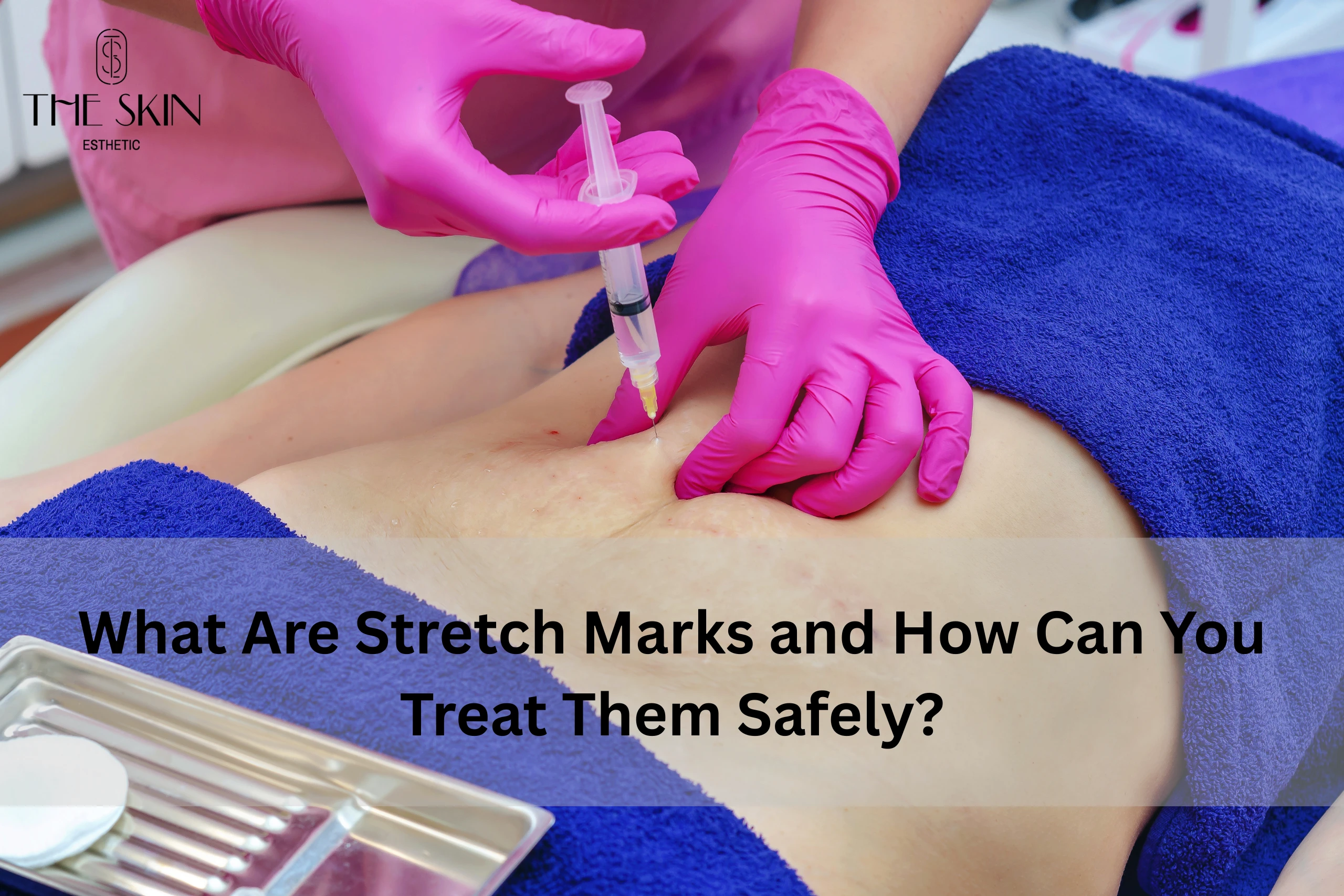 How to Treat stretch marks - The Skin Esthetics