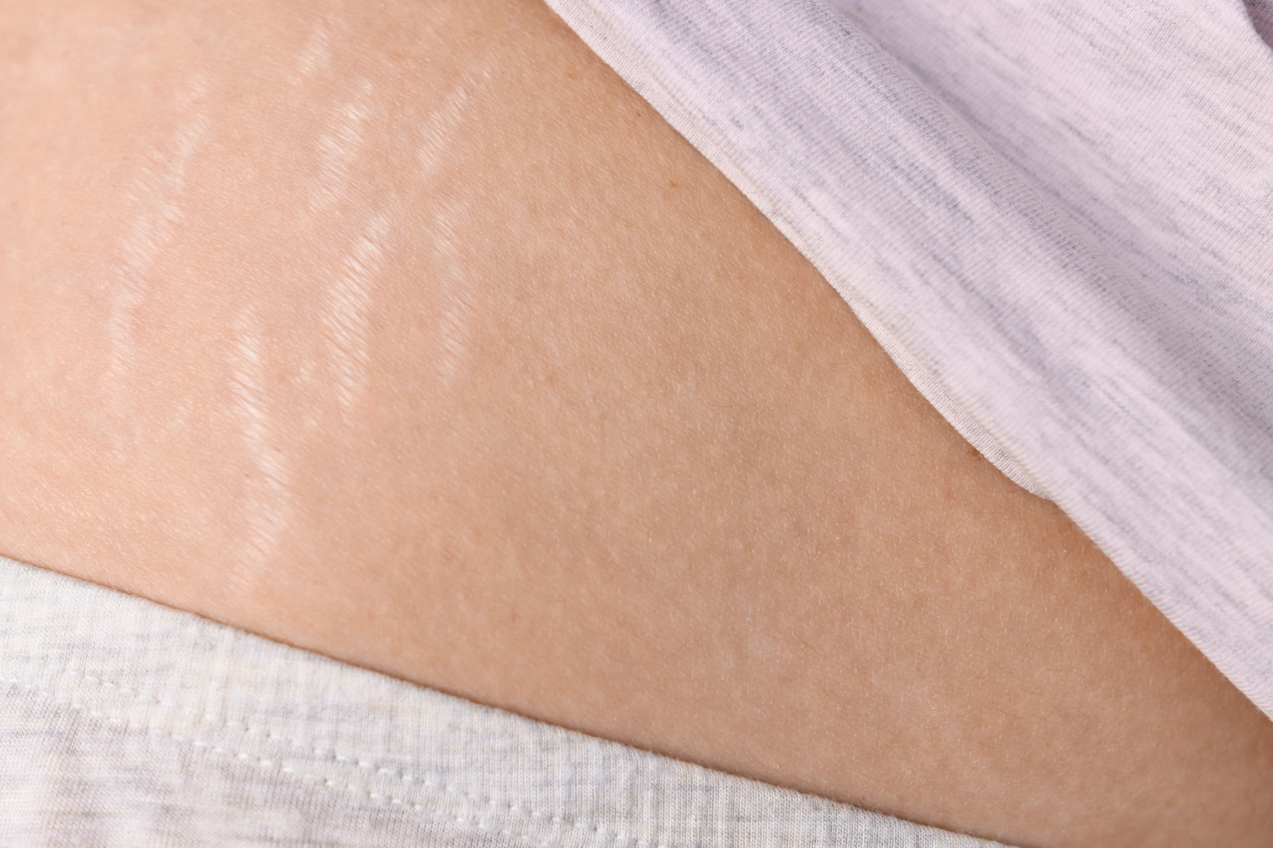 Stretch Marks - The Skin Esthetics