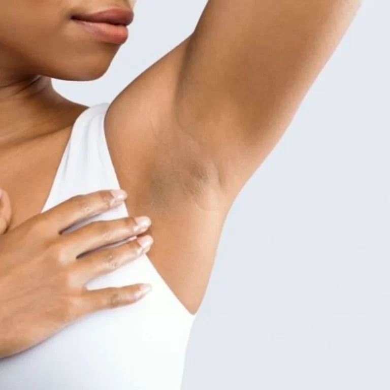 Underarm Pigmentation - The Skin Esthetic