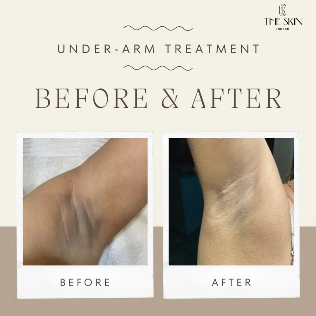 Underarm Pigmentation - The Skin Esthetic