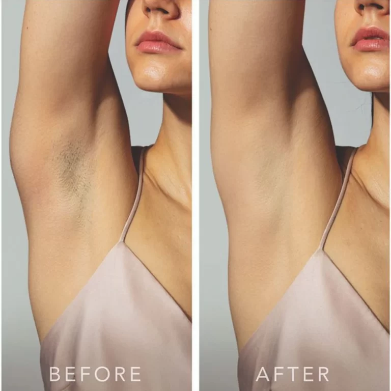 Underarm Pigmentation - The Skin Esthetic